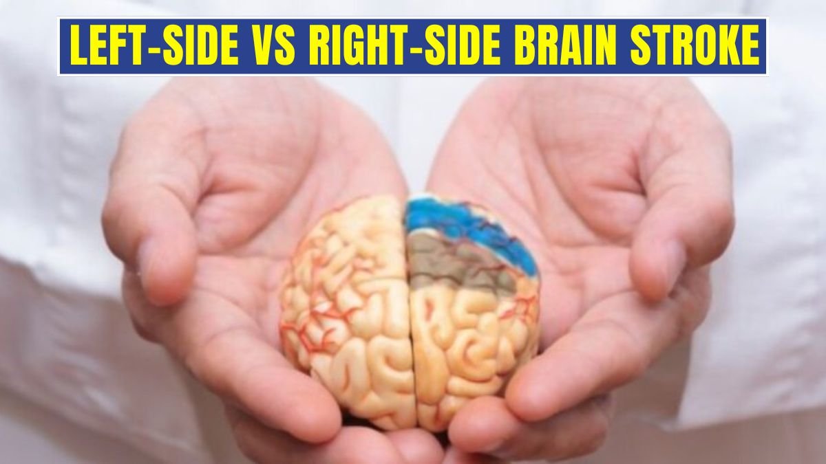 Left-Side vs Right-Side Brain Stroke: Symptoms & Recovery Differences